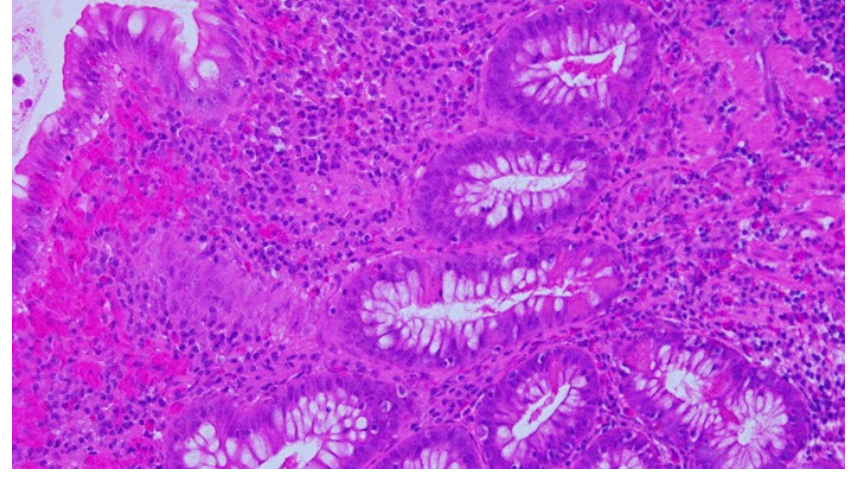 Photomicrograph of Paneth cell metaplasia in inflamed left colonic mucosa of a patient with ulcerative colitis, HE stain, 400x magnification.