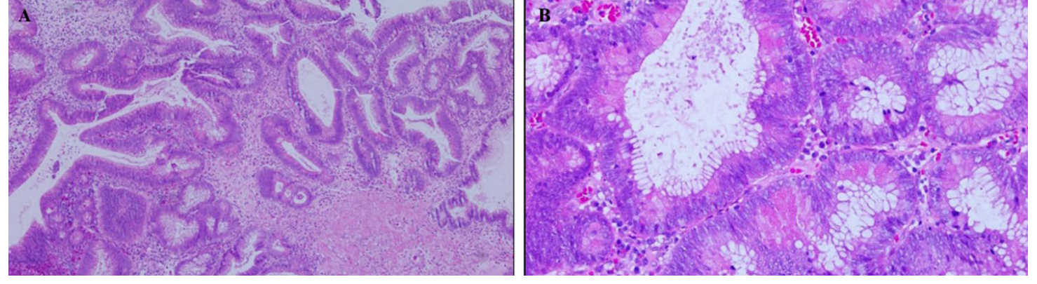 Photomicrographs, panels A and B, of Paneth cells within a tubulo-villous adenoma with low-grade dysplasia, HE stain, 100x and 400x magnification.