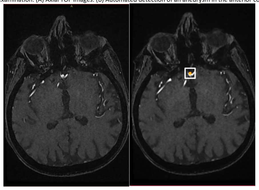 Brain MRI examination. (A) Axial TOF images. (B) Automated detection of an aneurysm in the anterior communicating artery.