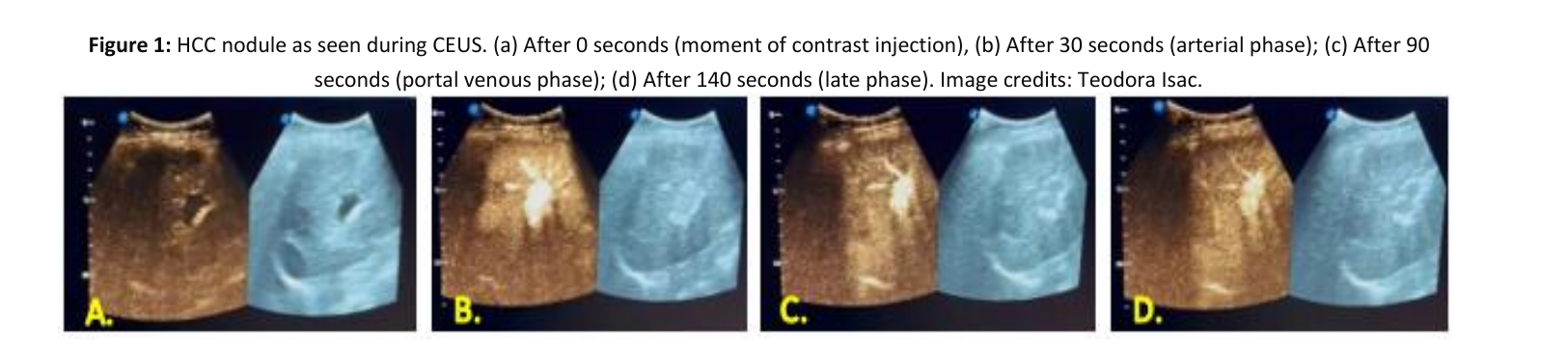 HCC nodule as seen during CEUS in four panels showing the arterial, portal venous and late phases after contrast injection.