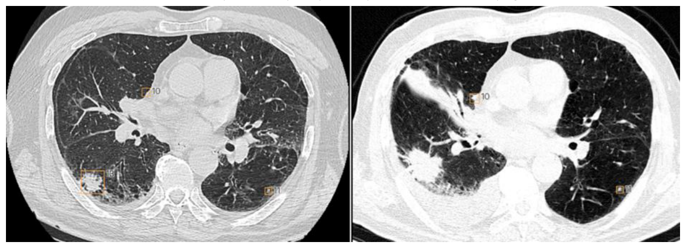 CT examination of axial sections, lung parenchyma window. Automatic identification of pulmonary nodular lesions and dimensional measurement.