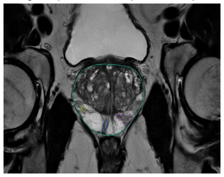 MRI examination, coronal T2 images of the prostate with automated prostate volume analysis and characterization of nodular lesions.